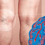 How Interventional Radiology Supports the Treatment of Deep Vein Thrombosis