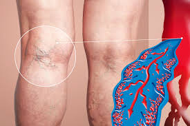 How Interventional Radiology Supports the Treatment of Deep Vein Thrombosis