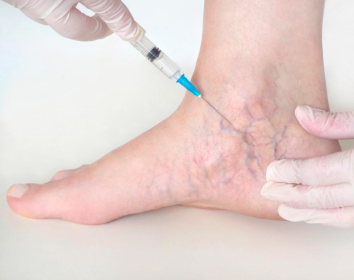 what are the most effective treatments for varicose veins?