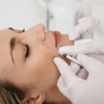 Botox for Smile Lines