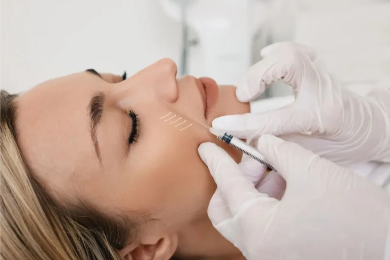 Botox for Smile Lines