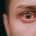 Common Causes of Red Eyes