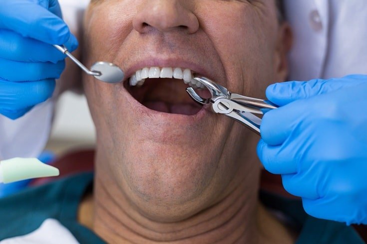 Healing Process After Tooth Extractions