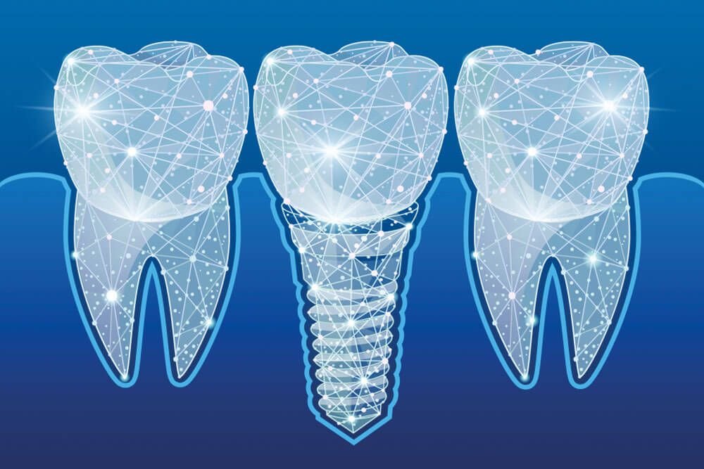 Innovations in Dental Implant Technology