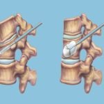 Kyphoplasty Procedure