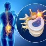 Long-Term Recovery from a Herniated Disc: What to Expect