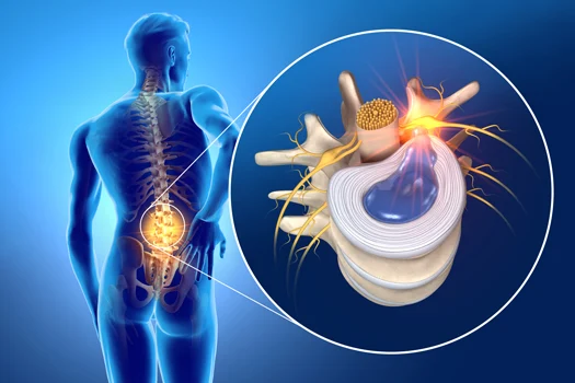 Long-Term Recovery from a Herniated Disc: What to Expect