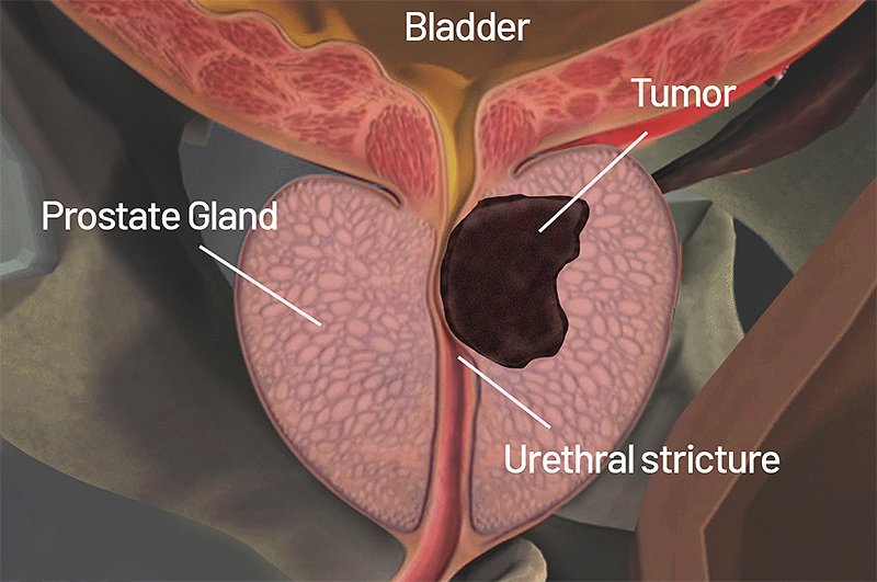 Prostate Cancer