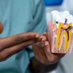 Root Canals