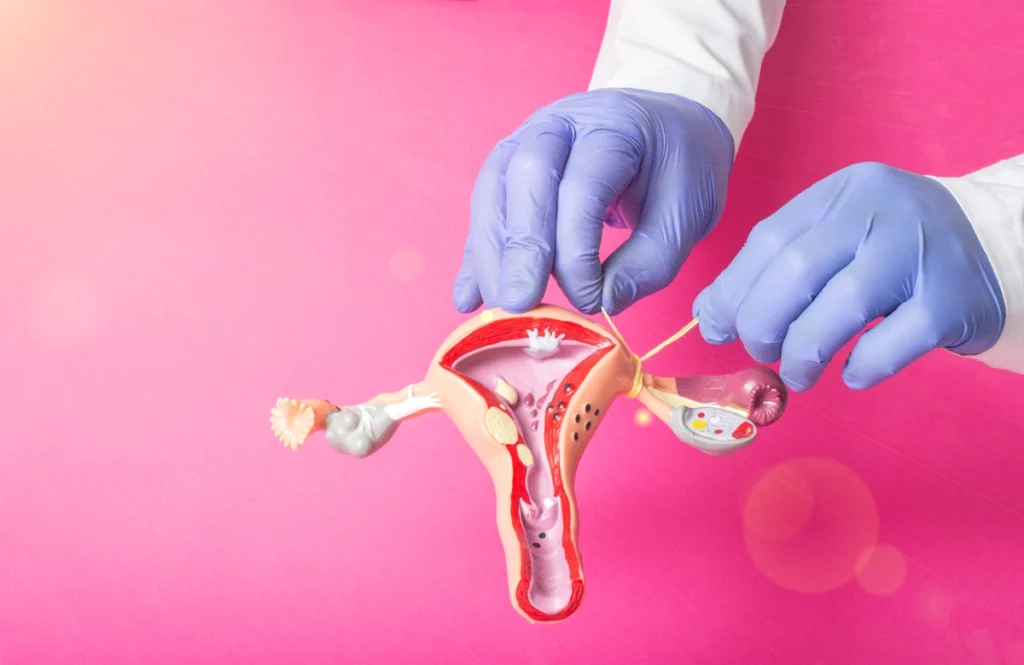 Tubal Reversal and IVF